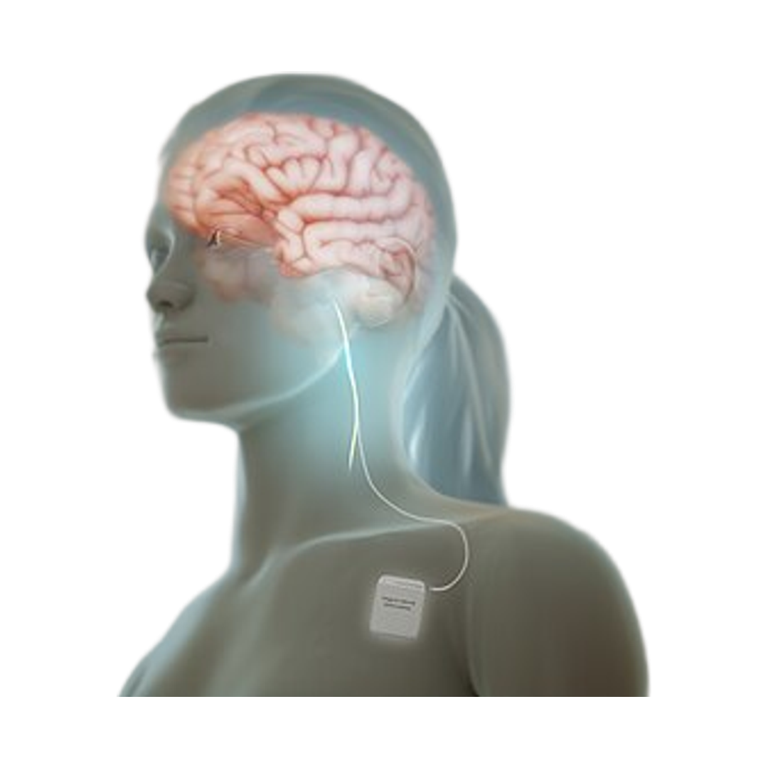 Vagus Nerve Stimulator